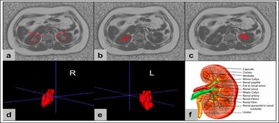 Quantification of the renal sinus fat and exploration of its relationship with ectopic fat deposition in normal subjects using MRI fat fraction mapping